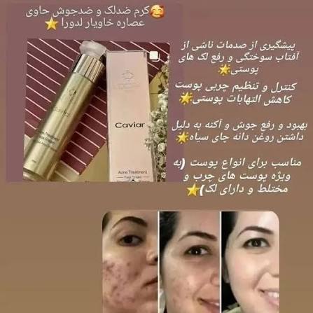 ضد لک و ضد جوش خاویار